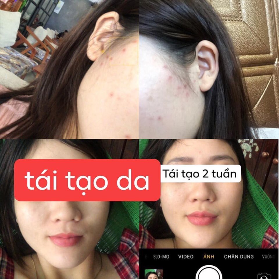 THẢO DƯỢC MT SẠCH MỤN THÂM RỖ (100ml)