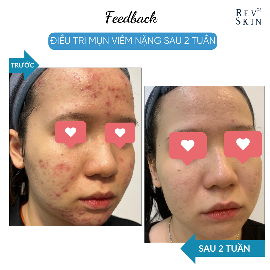 Combo Sạch Mụn RevSkin - Sữa Rửa Mặt + Kem Chấm Mụn