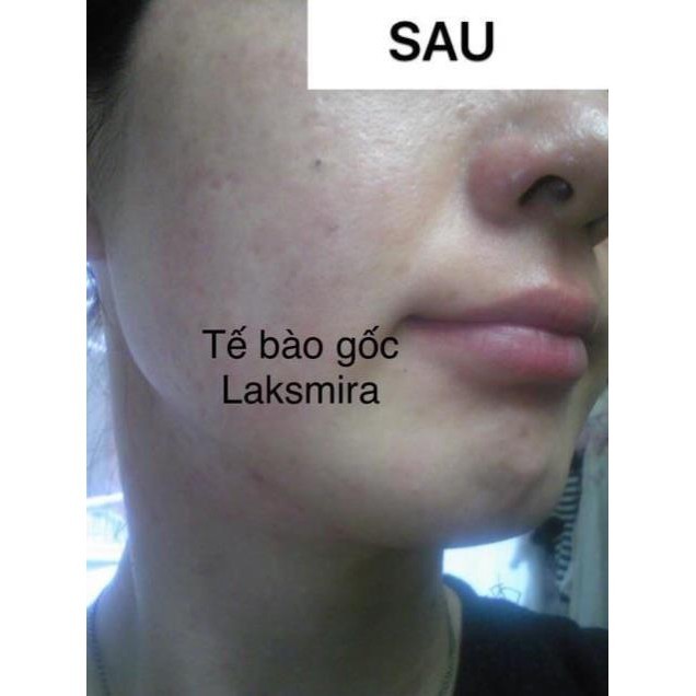( Mẫu Mới 2019 ) TẾ BÀO GỐC LAKSMIRA STEM CELL SOLUTION ( Lẻ 1 ống )