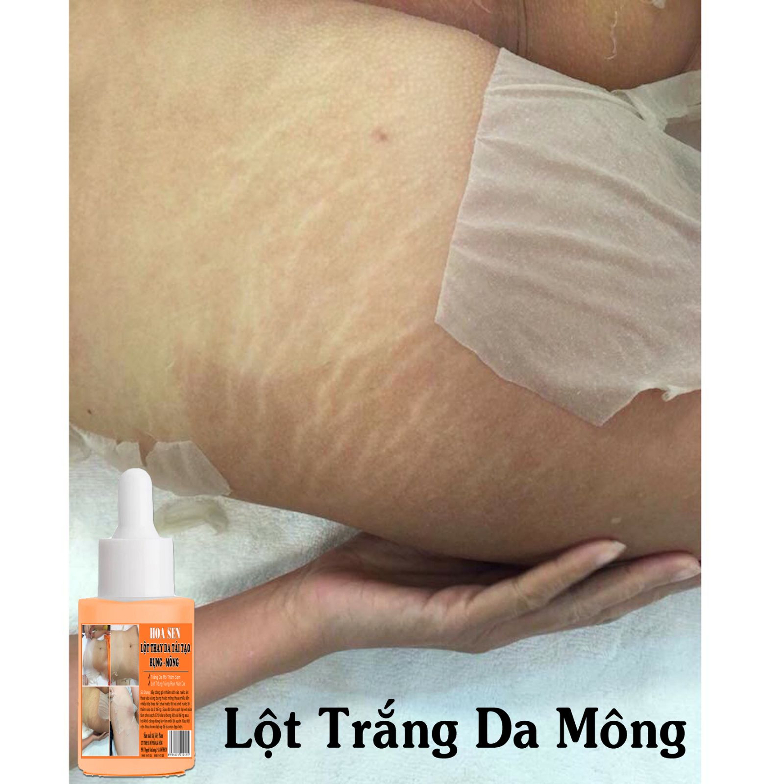 Lột Trắng Da Bụng Mông Bẹn Mờ Rạn Da Thâm Sạm