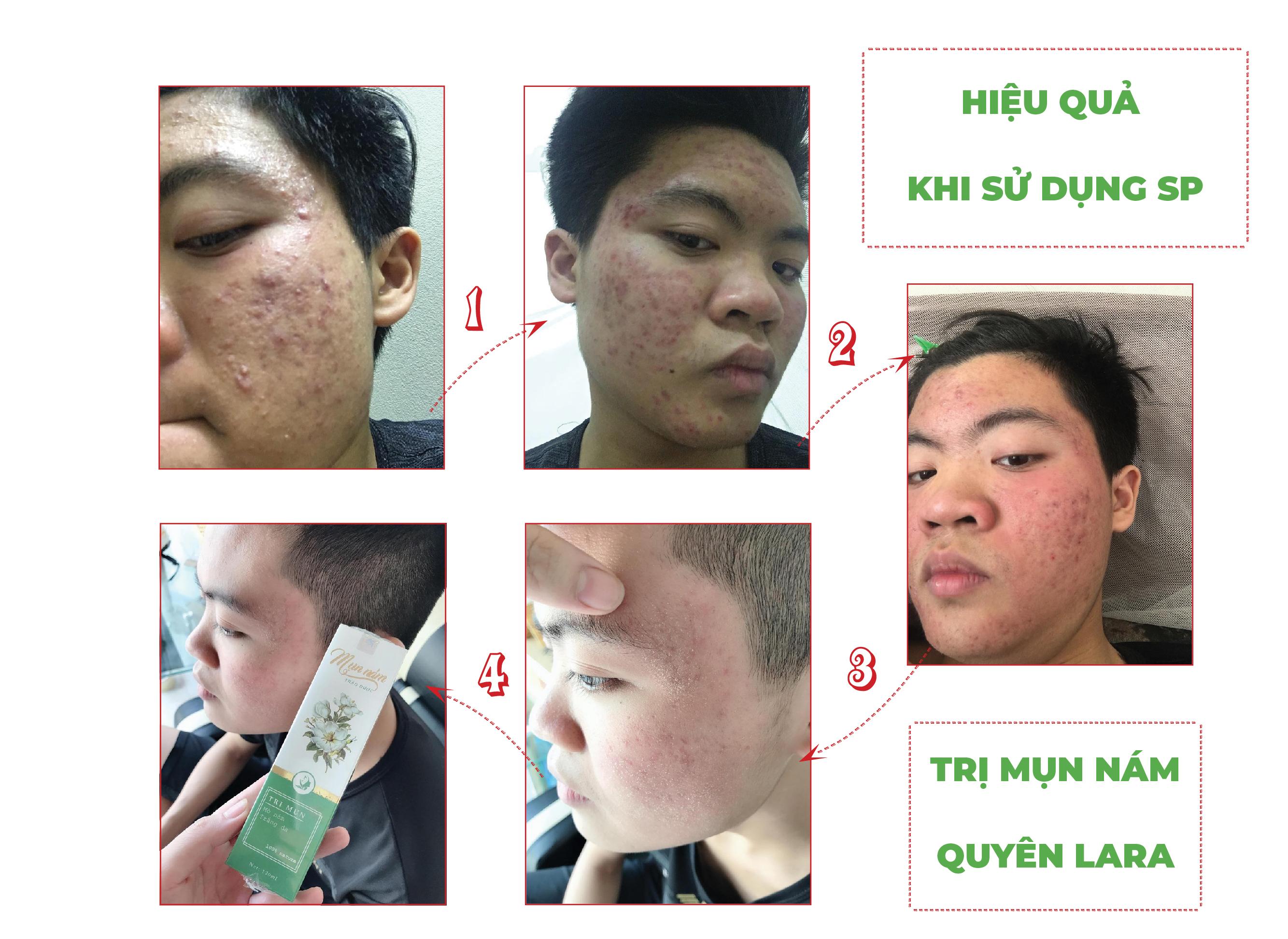 Mụn nám thảo dược Quyên Lara 120ml