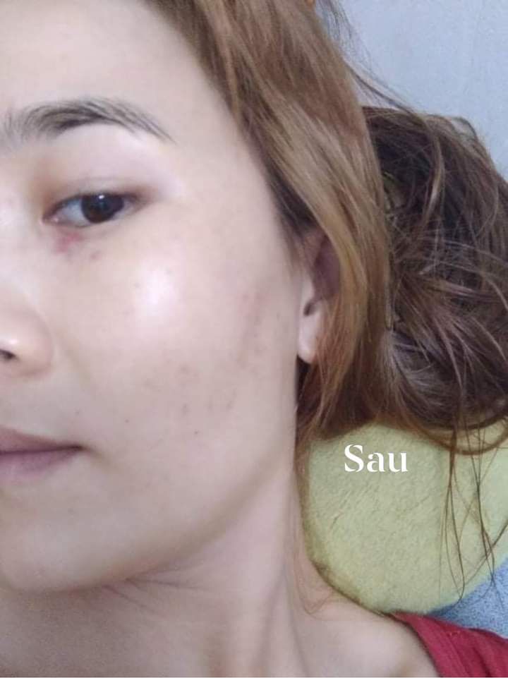 Serum Nhân Sâm Phục hồi da mỏng chỉ đỏ