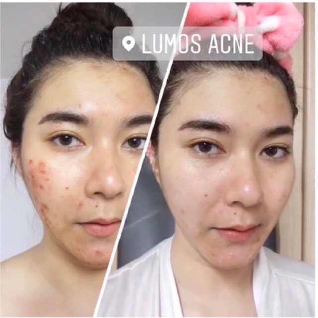 [MẪU MỚI] SERUM MỤN LUMOS ACNE 5ML- XÓA MỤN [CHÍNH HÃNG]