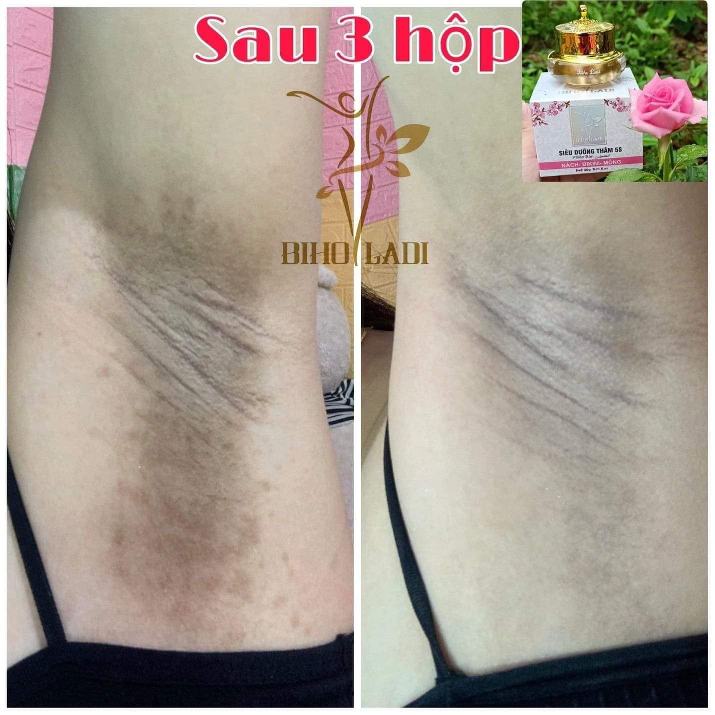 Siêu Dưỡng Thâm 5s Biho Ladi