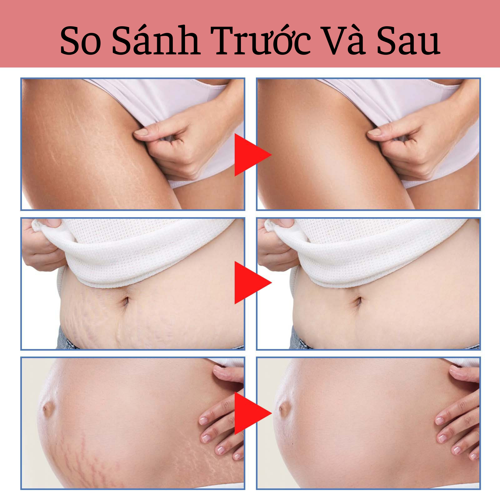 Kem Trị Rạn Da Sau Sinh Cho Bà Bầu Wiieey Cải Thiện Nếp Nhăn, Phục Hồi Độ Đàn Hồi Cho Da, Giữ Làn Da Mịn Màng Tươi Trẻ