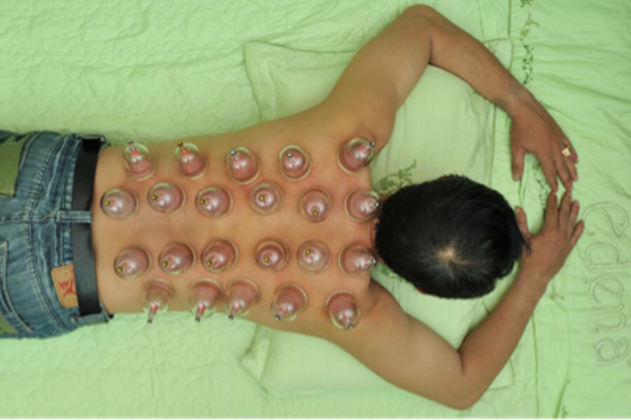 Bộ Giác Hơi Không Dùng Lửa YGH02