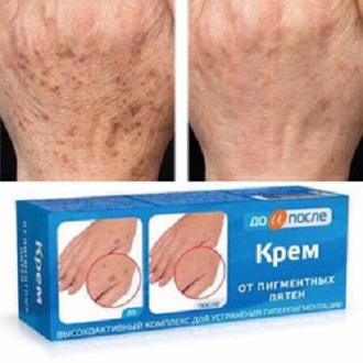 Kem Trí Đồi Mồi Tay Chân Kpem