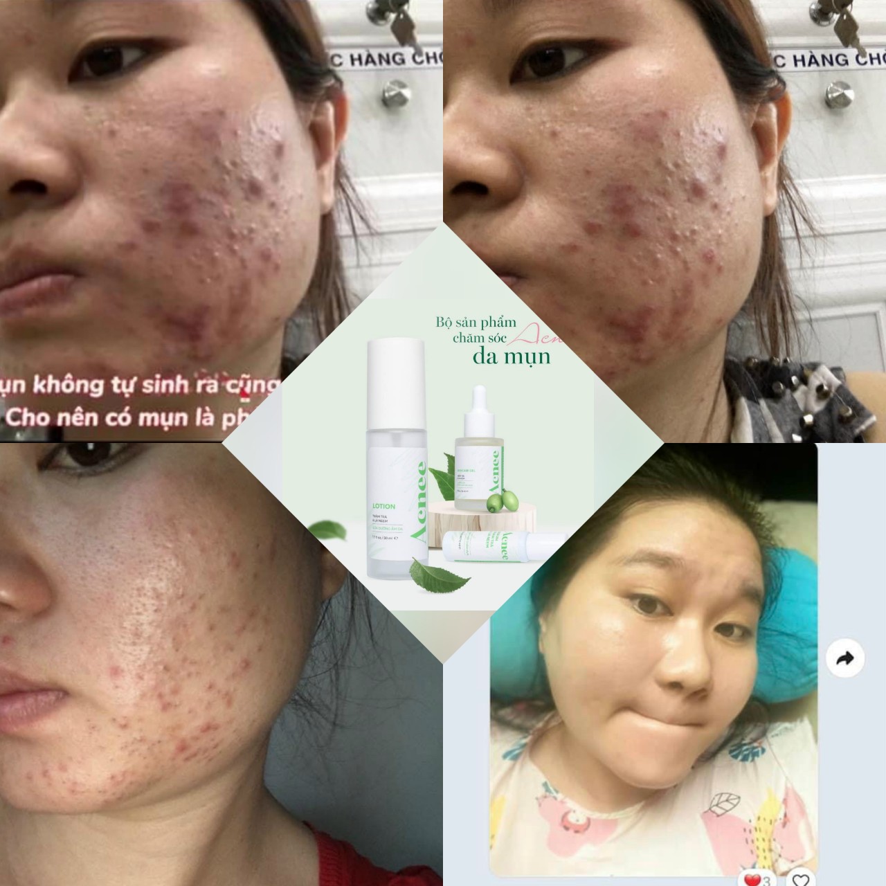Trị Mụn Laco - bộ 3 Trị Mụn Laco [Tặng Sữa Rửa mặt]