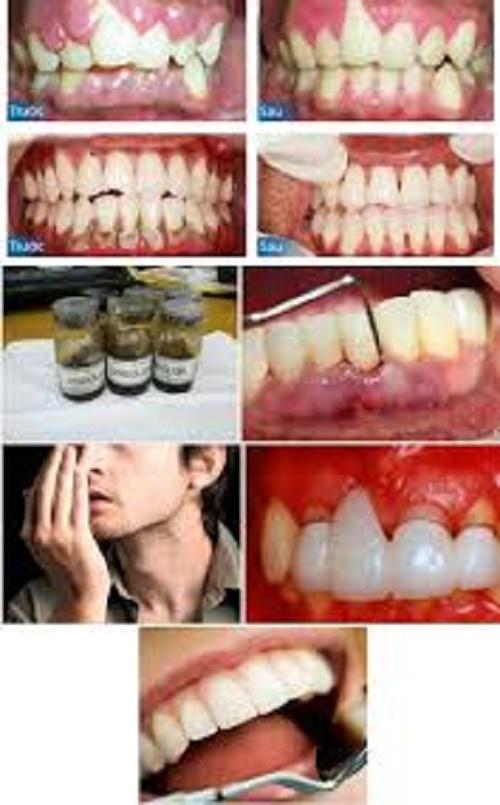 THUỐC CHẤM VIÊM LỢI SINDOLOR
