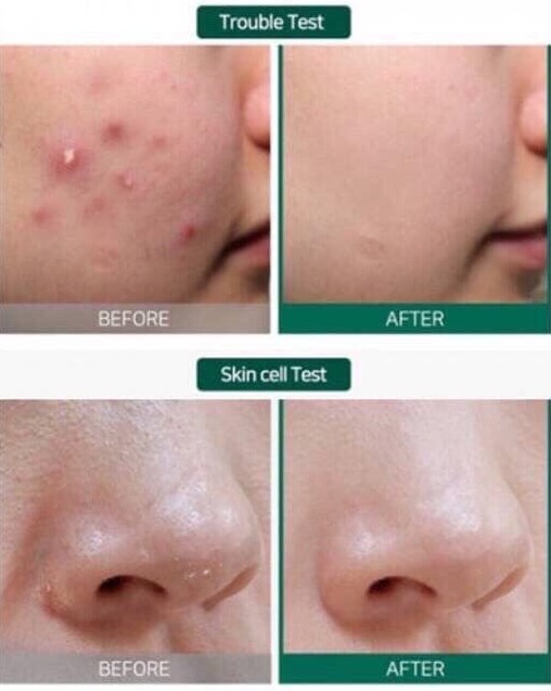 Kem dưỡng some By Mi Aha Bha Pha 30 Days Miracle Cream