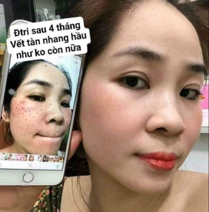 [Genuine] Yody Phuong Anh Skin Peeling Treatment Helps Even Skin Tone