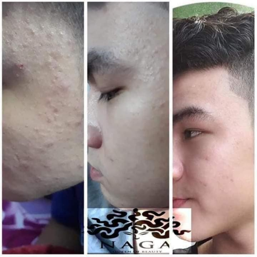 [Chính hãng] Kem chấm mụn mờ thâm, giảm nhanh mụn viêm, mụn thâm