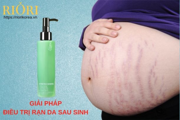Kem trị rạn da Stretch Marks Riori