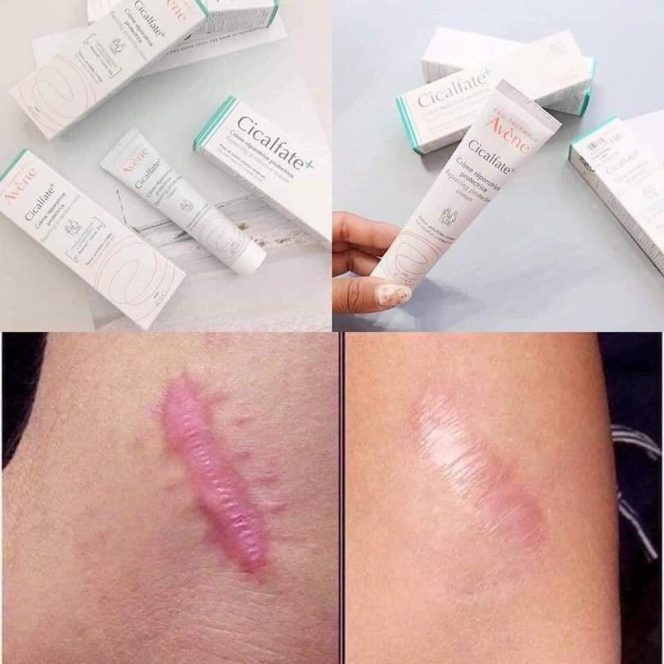 Kem dưỡng giảm thâm sẹo Avene 100ml