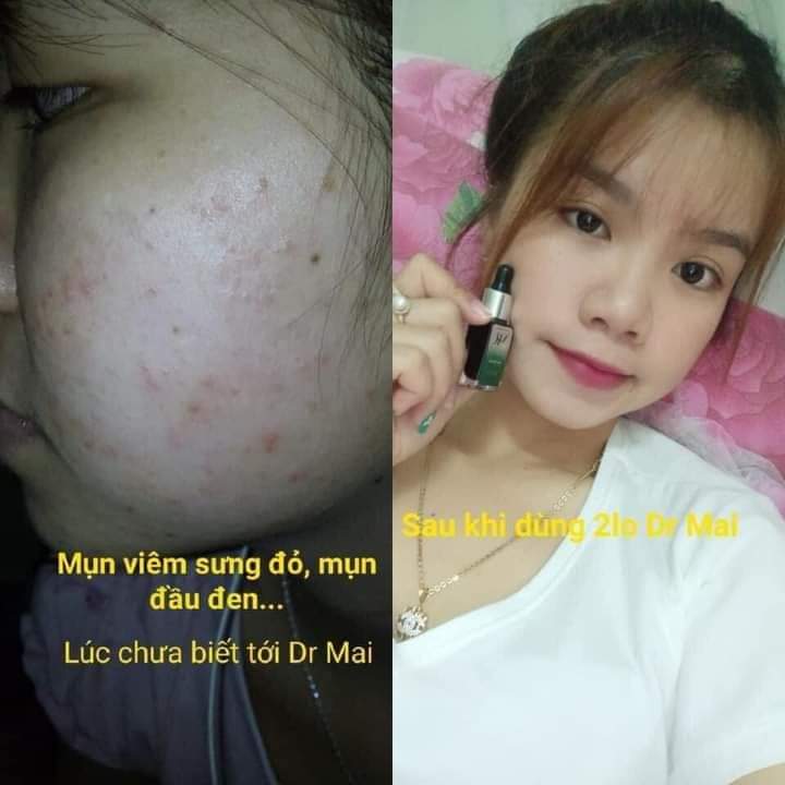 [HCM]Serum Cải Thiện Thân rổ Mr Mai Mix