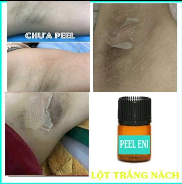 [HCM]PEEL LỘT TRẮNG DA NÁCH. HẾT THÂM(Tặng kem dưỡng)