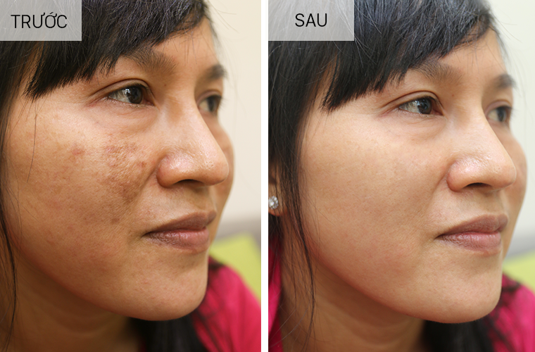 Serum nám Hoa Anh Đào 30ml
