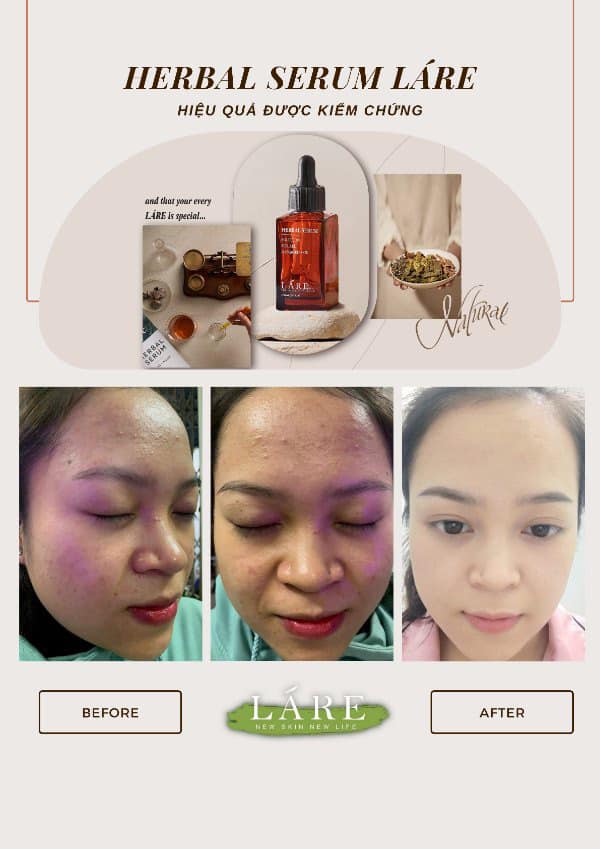 Combo Thanh Dược Lare( serum 50ml+mask trắng da 120gr+srm12gr)