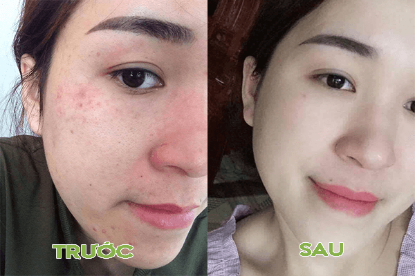[HCM]Tái Tạo Da Hết Mụn Hết Nám Sạm Trắng Hồng