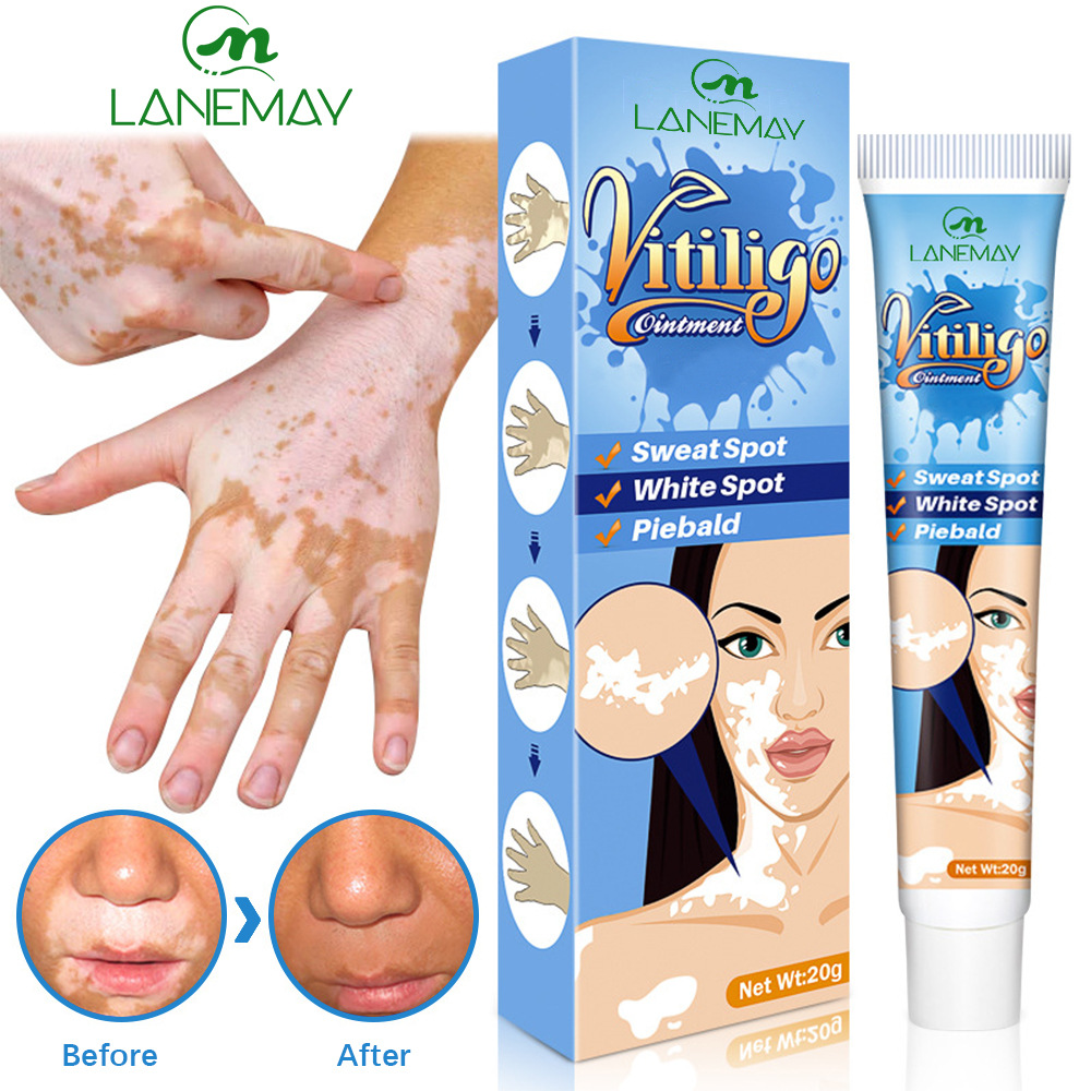 Kem lang ben thảo mộc VITILIGO