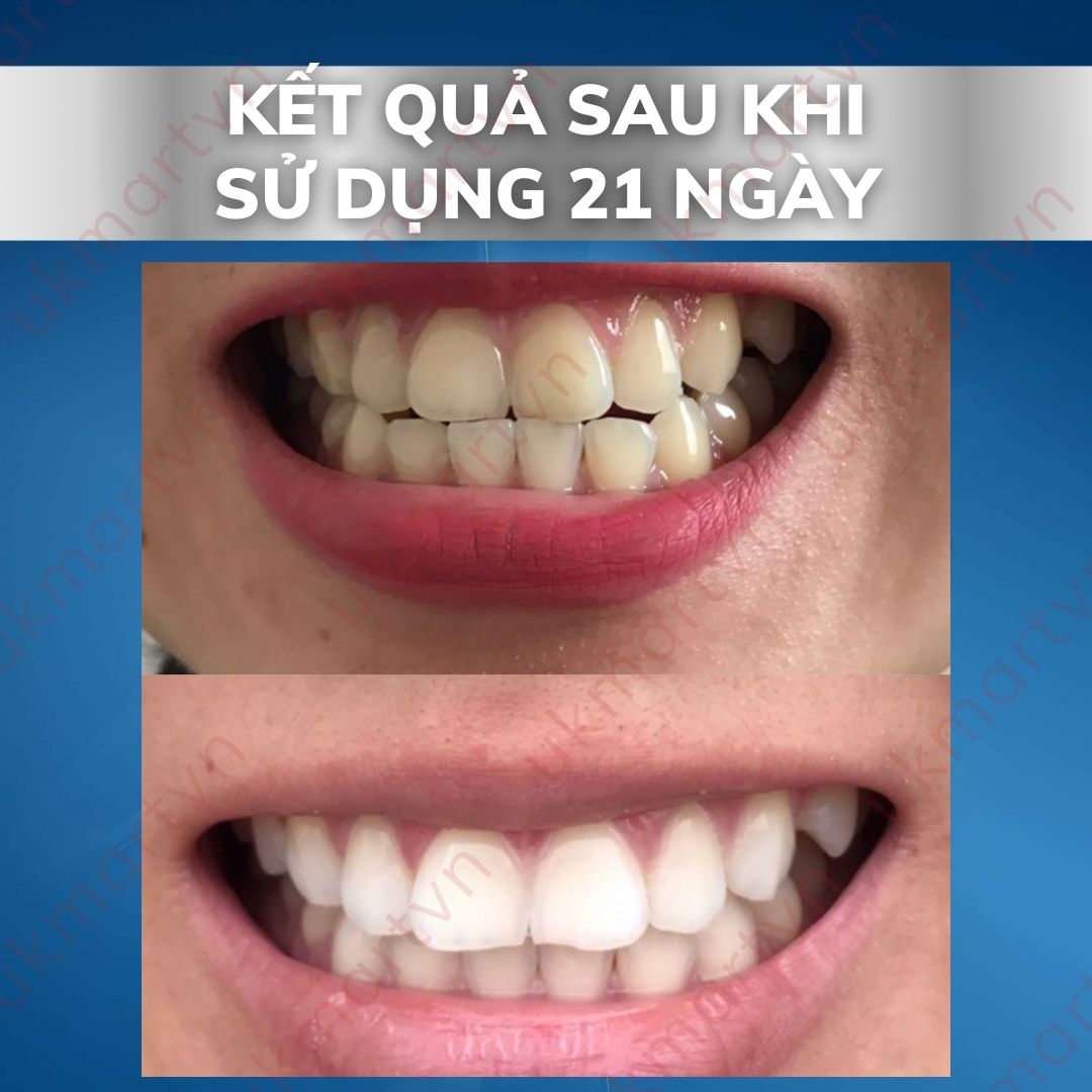 Miếng Dán Trắng Răng Crest Whitestrips Supreme Professional - White Effects