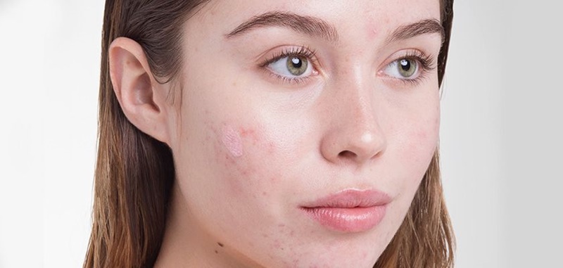 Serum tri Mụn Bọc tận gốc  Doctor Care