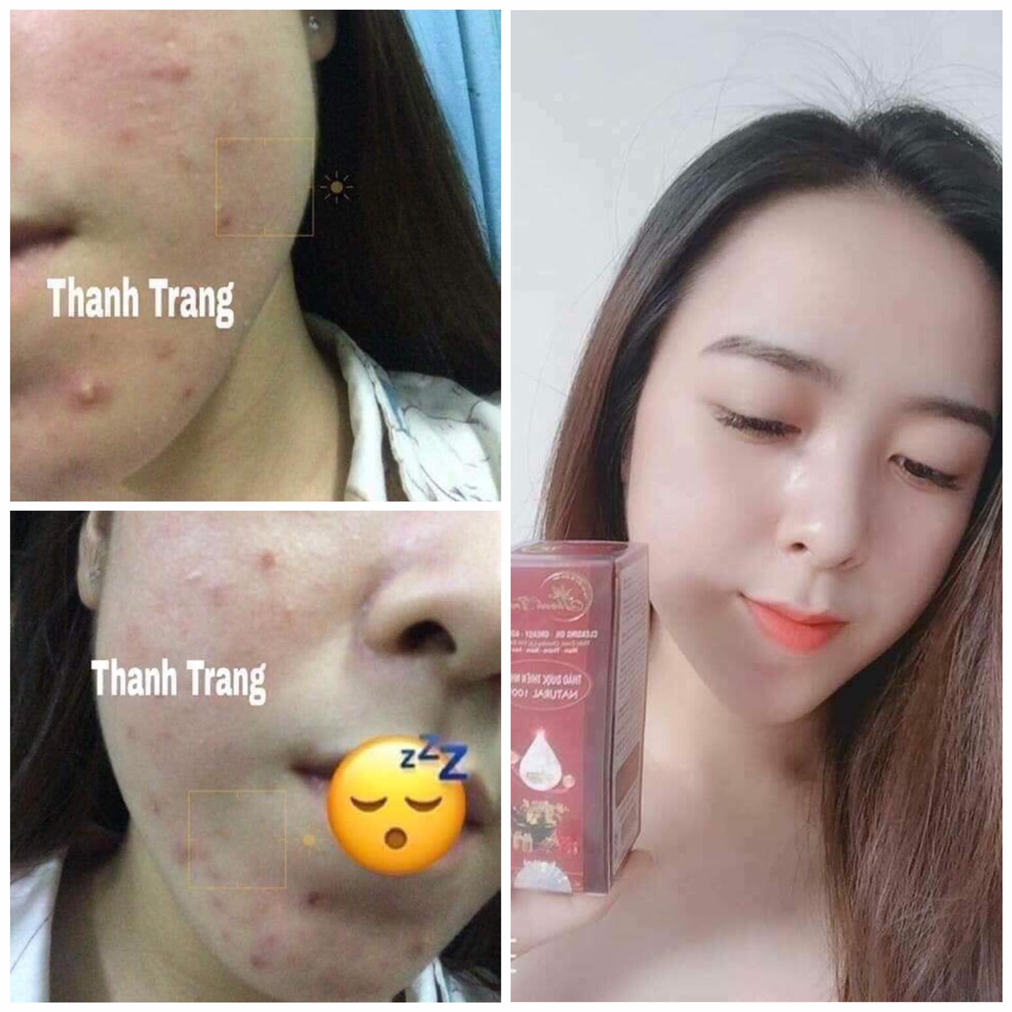 Linh chi vi mụn