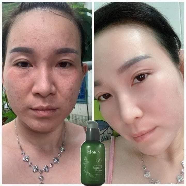 TÁI TẠO DA NHÂN SÂM MSKIN HÀN QUỐC
