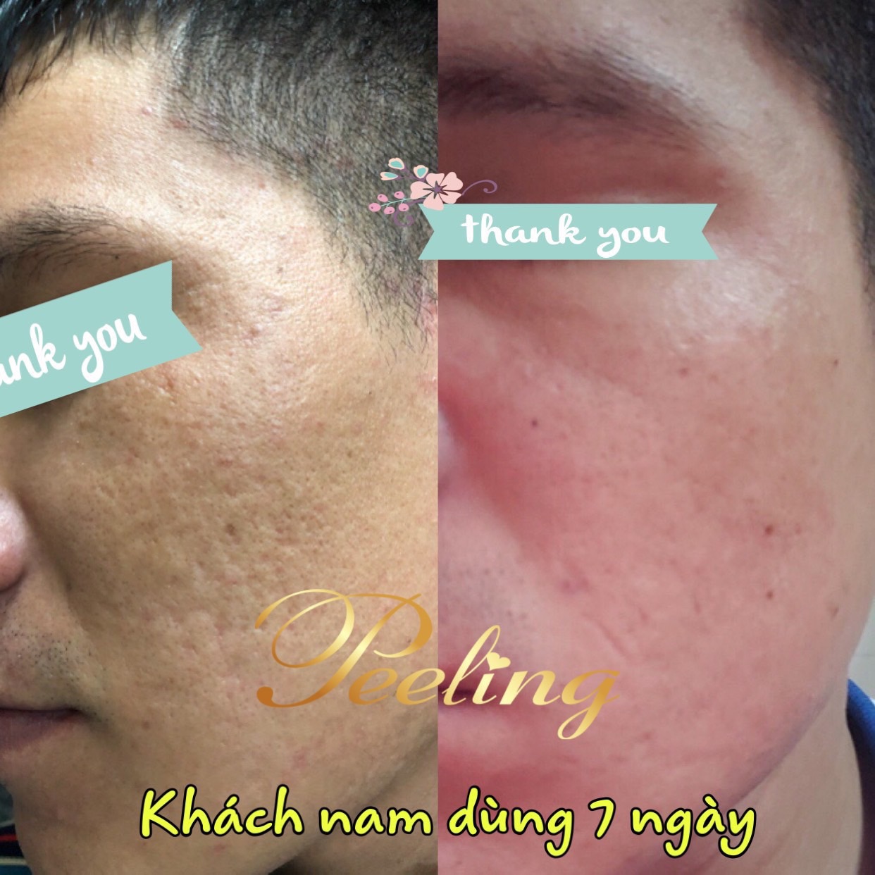 [HCM]kem Peeling Tái tạo da