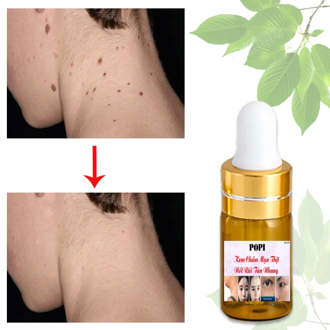 [HCM]Kem Xóa Nốt Ruồi Tàn Nhang Đồi Mồi