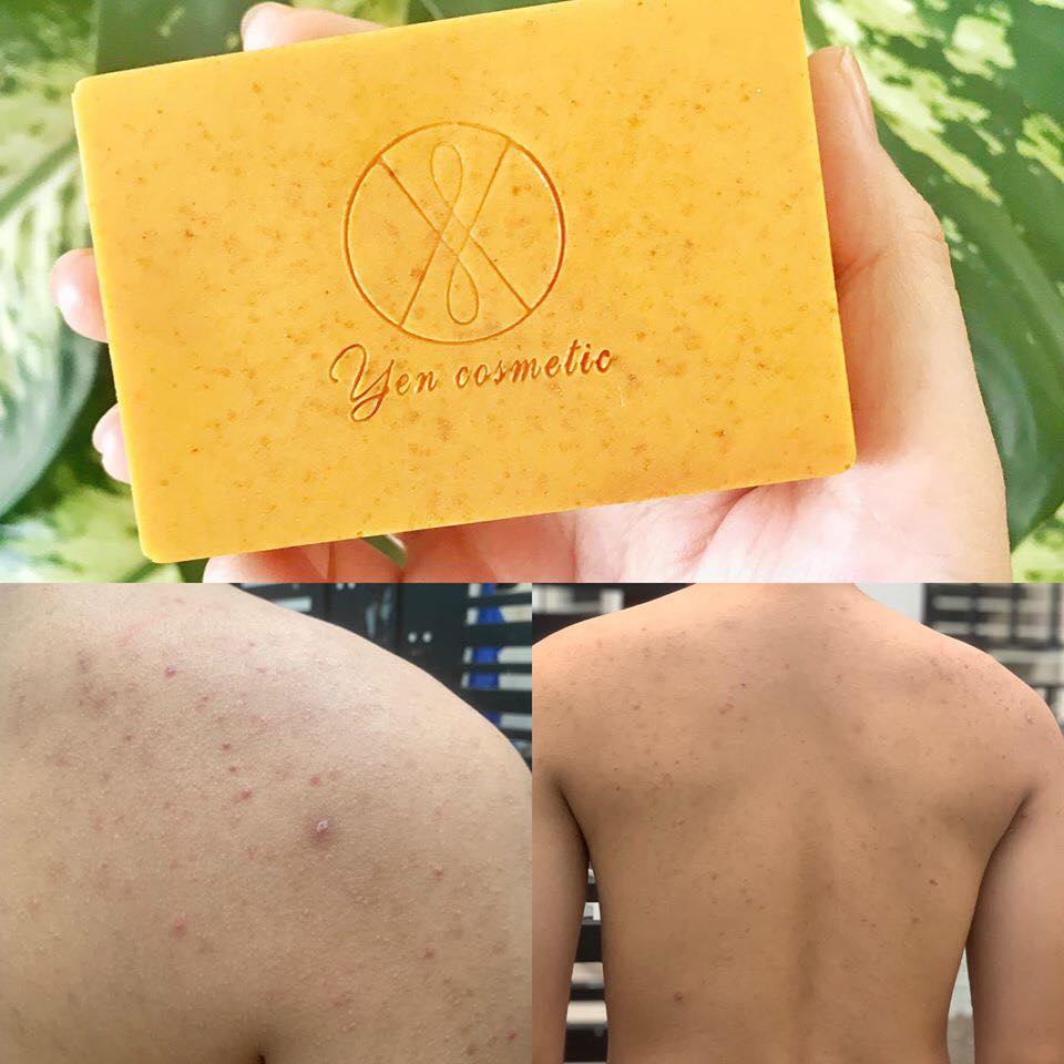 Soap nghệ - tràm trà giải quyết mụn lưng