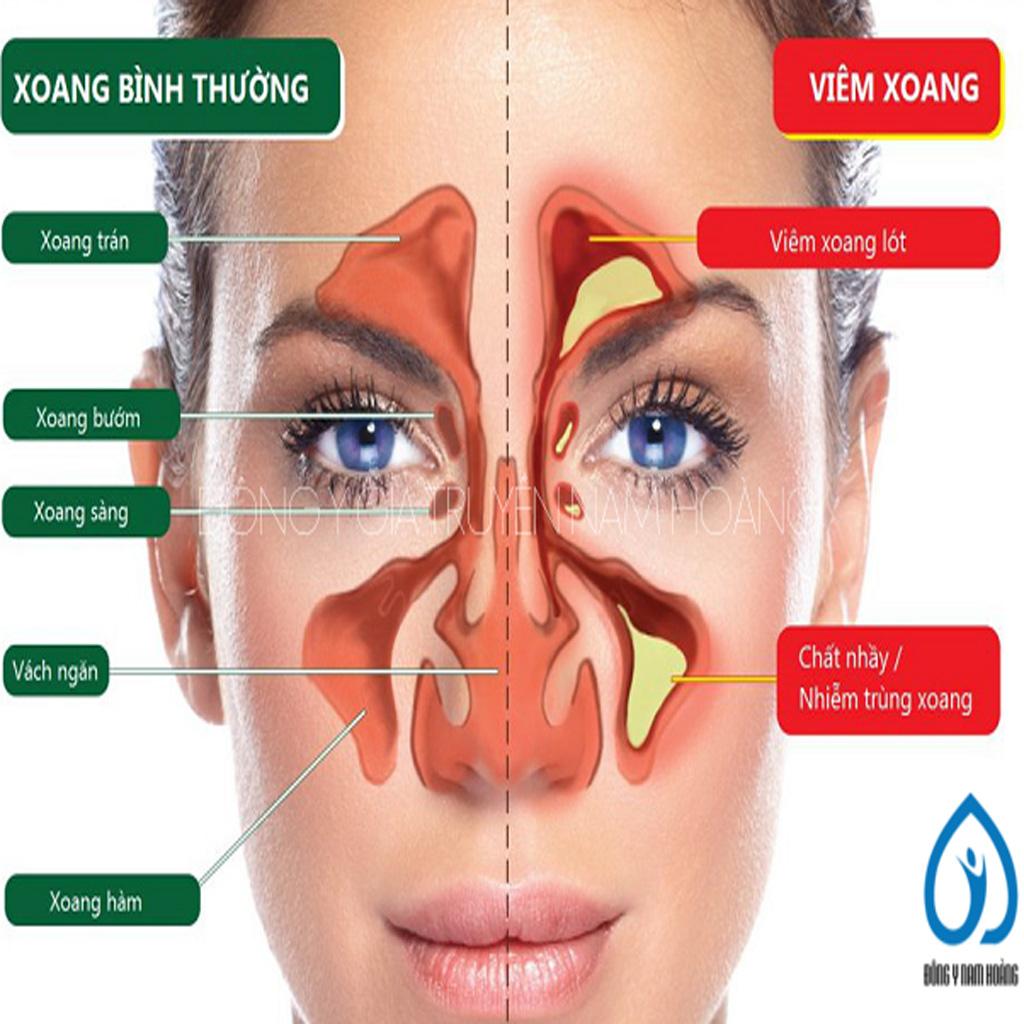 Thuốc Chữa Viêm Xoang Nam Hoàng