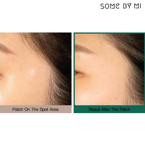 Miếng Dán Hỗ Trợ Giảm Mụn Some By Mi Clear Spot Patch 18 Miếng