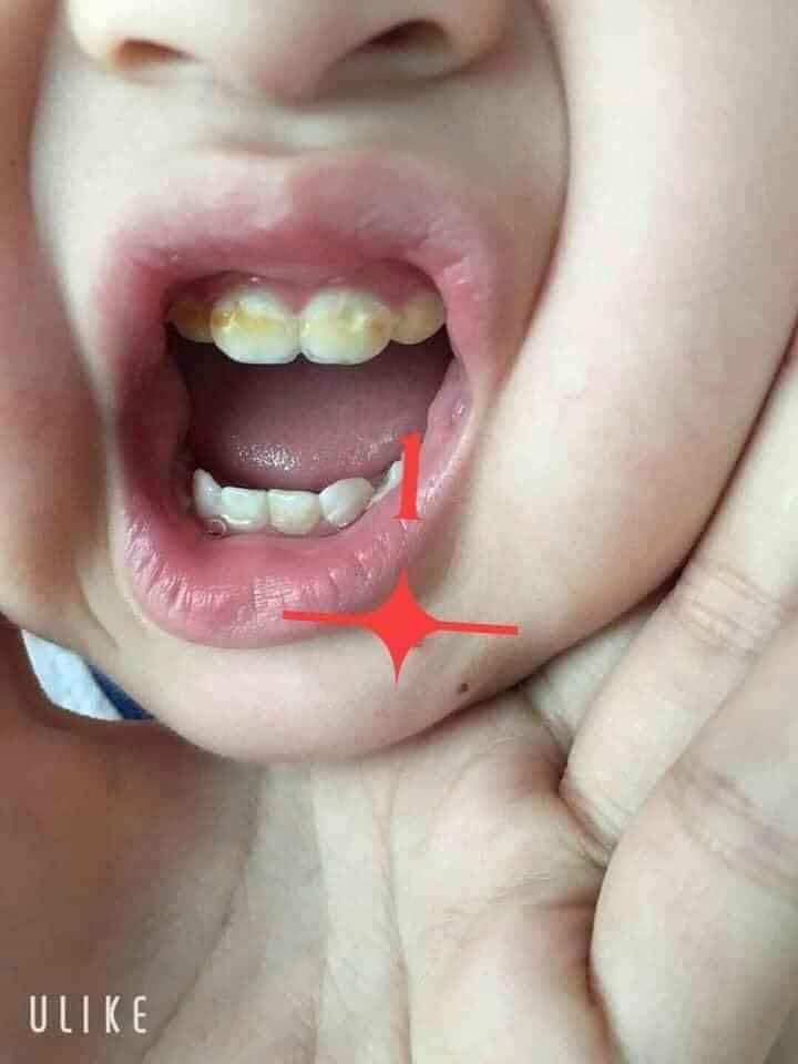 Sâu răng Nhật Dương