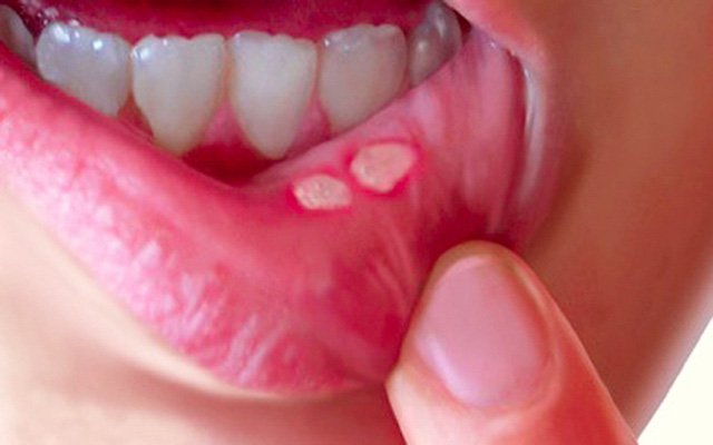 Kem bôi nhiệt miệng Peridex Hàn Quốc 6g (mẫu mới nhất)