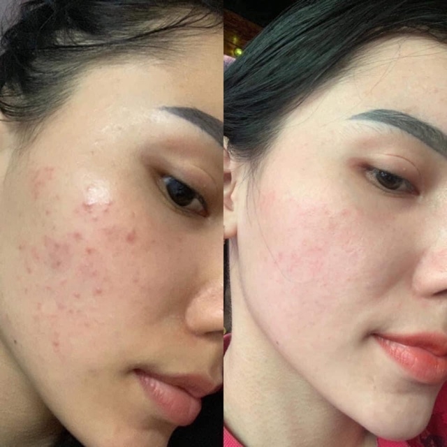 Serum trị mụn Huyết mộc nhan