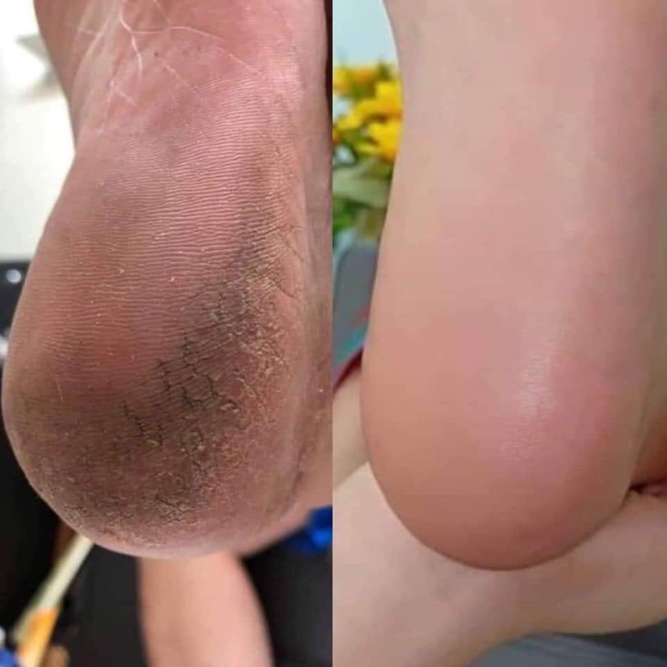 Dụng Cụ Chà, Dũa Gót Chân LD chà gót chân