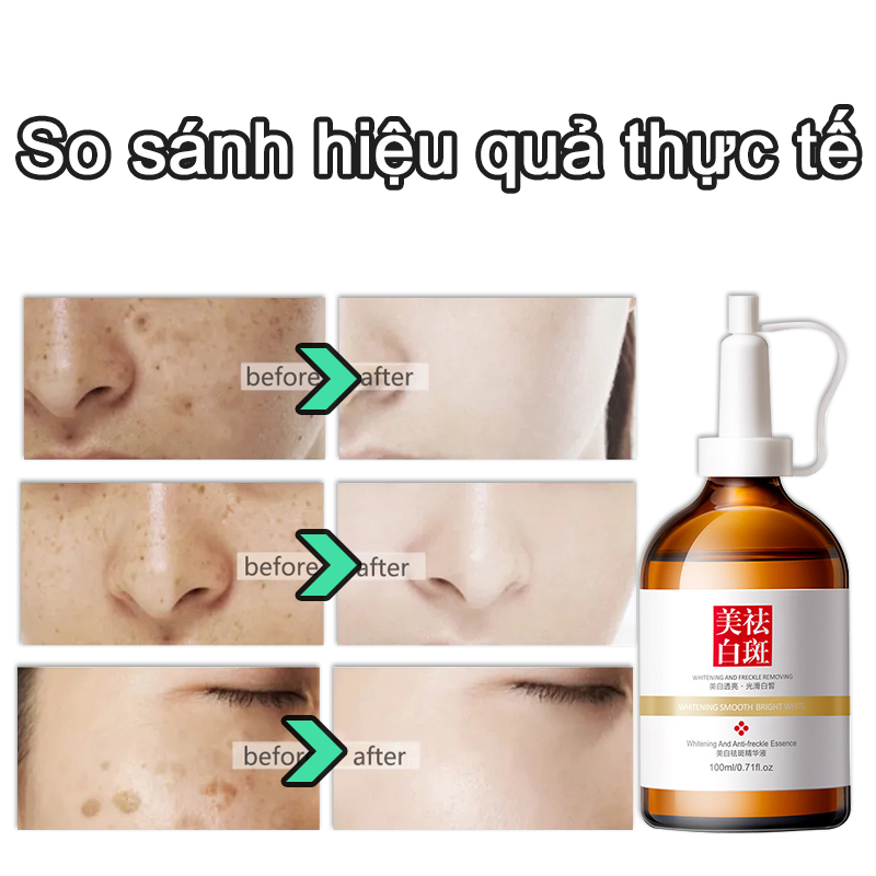 tinh chất làm trắng serum thâm mụn Huyết thanh chống tàn nhang sử dụng trắng hết nhăn nám tàn nhang không tì vết chất làm săn chắc lỗ chân lông tinh chất dưỡng ẩm mặt thu nhỏ lỗ chân lông săn chắc 100ml