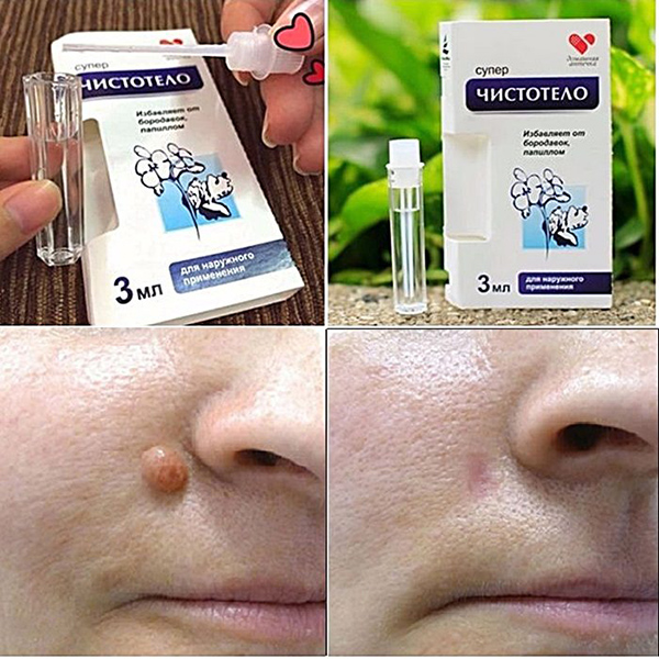 Combo 2 Chai Gel tẩy nốt ruồi,mụn thịt chuẩn Nga - hàng xịn