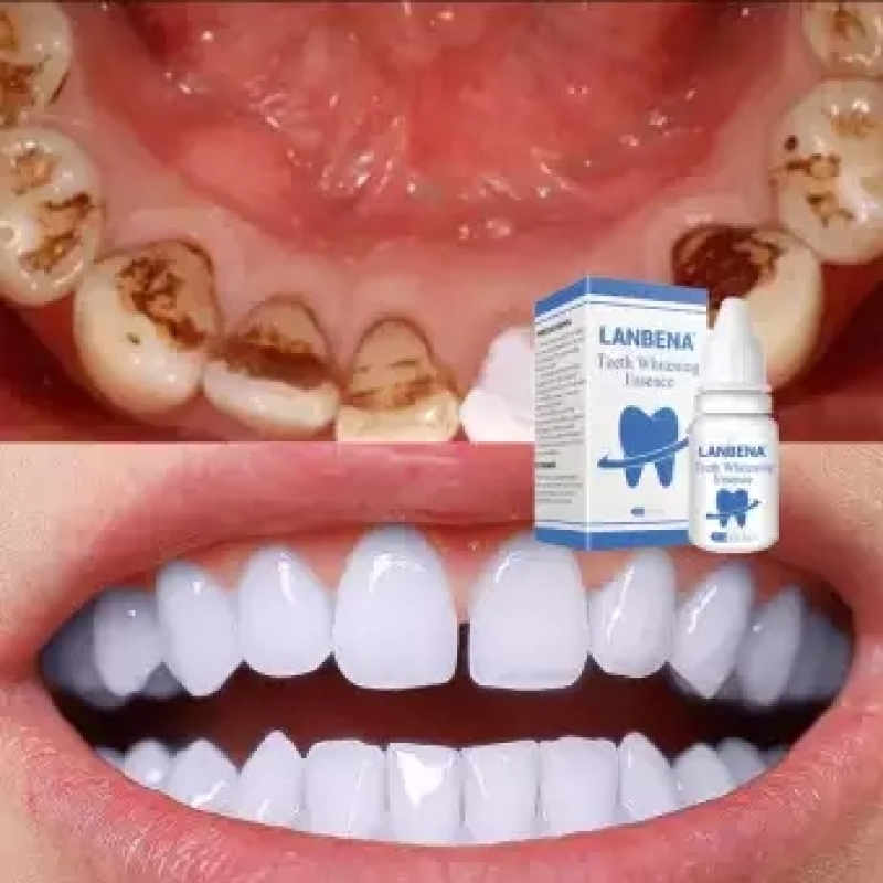 [HCM]Tinh Chất Tẩy Trắng Răng Làm Sạch Răng Miệng Khử Mùi Hôi Miệng Oral Teeth Whitening Essence LANBENA 15ml