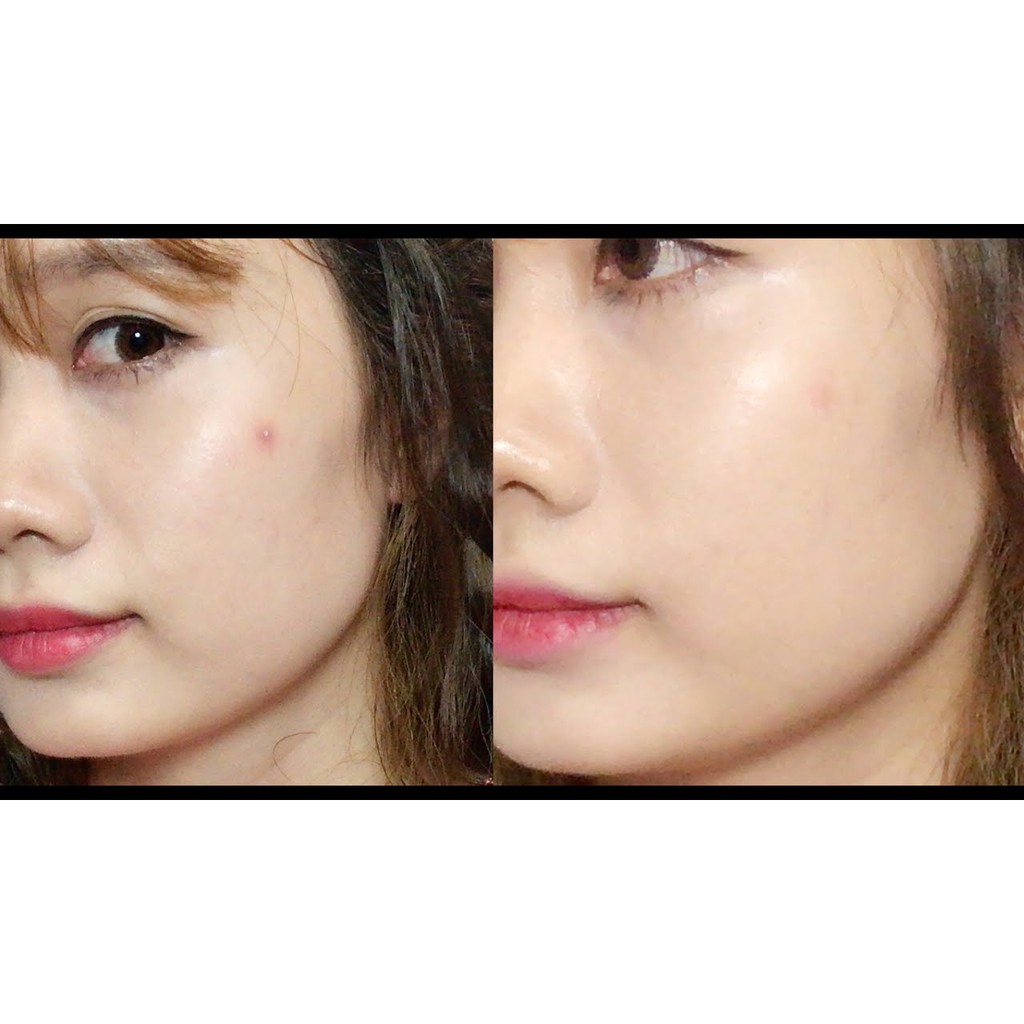 Miếng dán mụn Cosrx Acne Pimple Master Patch (Đỏ) / Cosrx Clear Fit Master Patch (Đen) / Cosrx AC Collection Acne