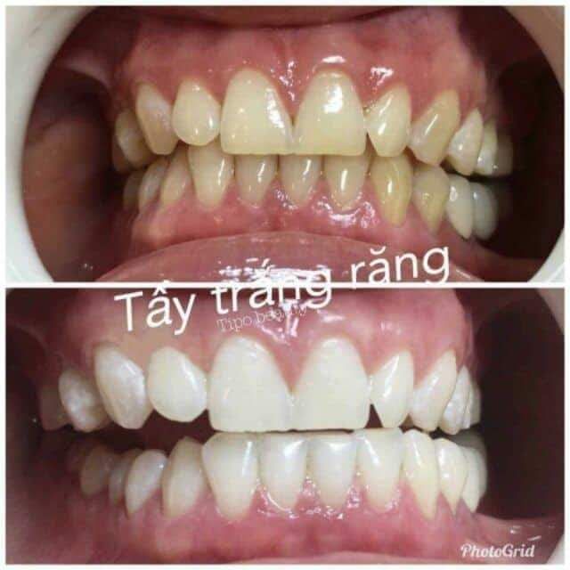 Máng Tẩy Trắng Răng Tại Nhà Khít Răng 100%