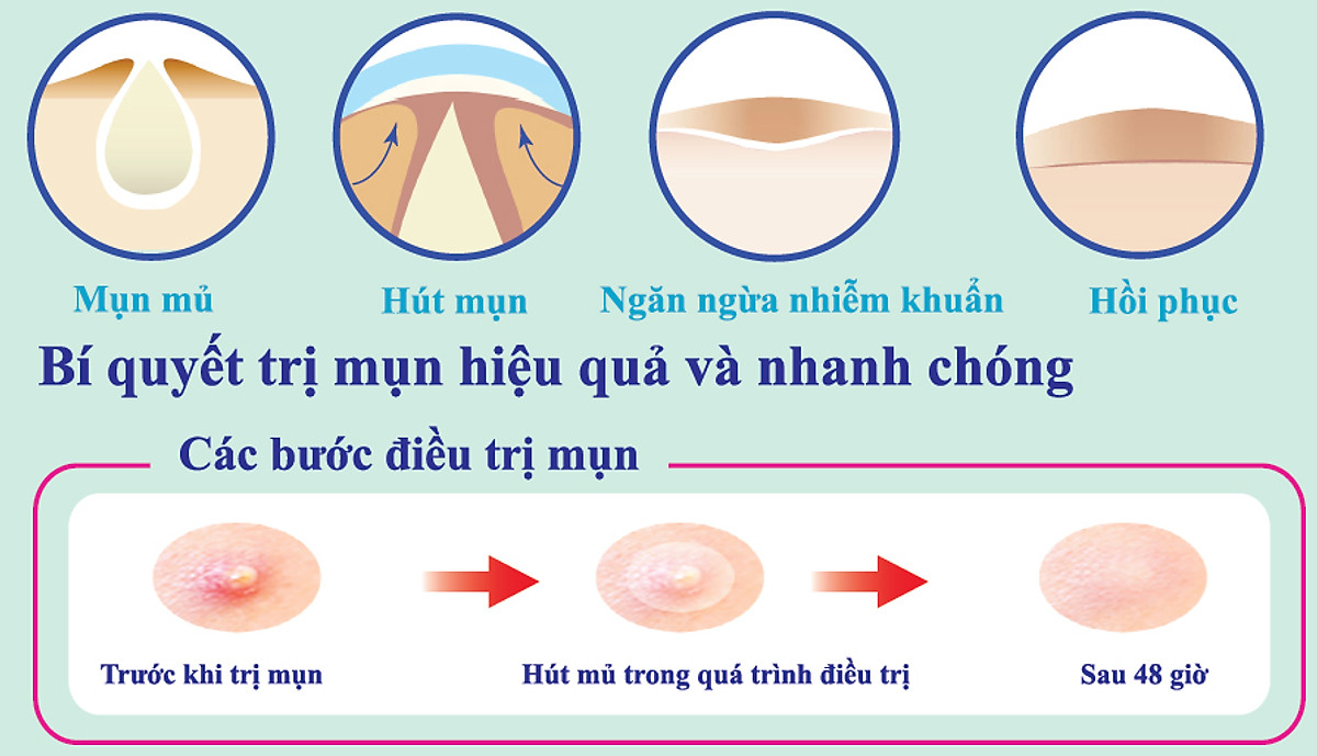 [CHÍNH HÃNG] Miếng Dán Mụn Somaderm 12 ( Hộp 12 Miếng)