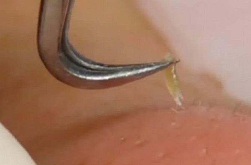 NHÍP GẮP MỤN ĐẦU ĐEN