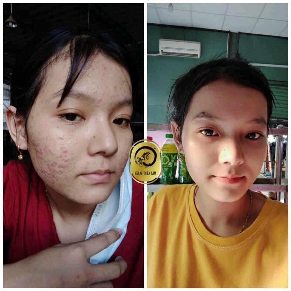 MỤN S.O.S HOÀNG THIÊN SÂM