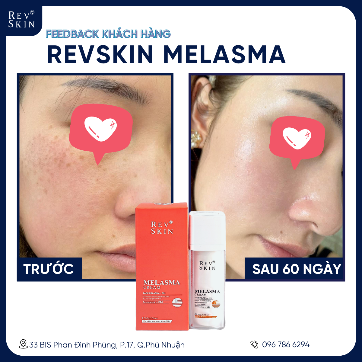 Kem Làm Mờ Thâm, Nám - RevSkin Melasma Cream
