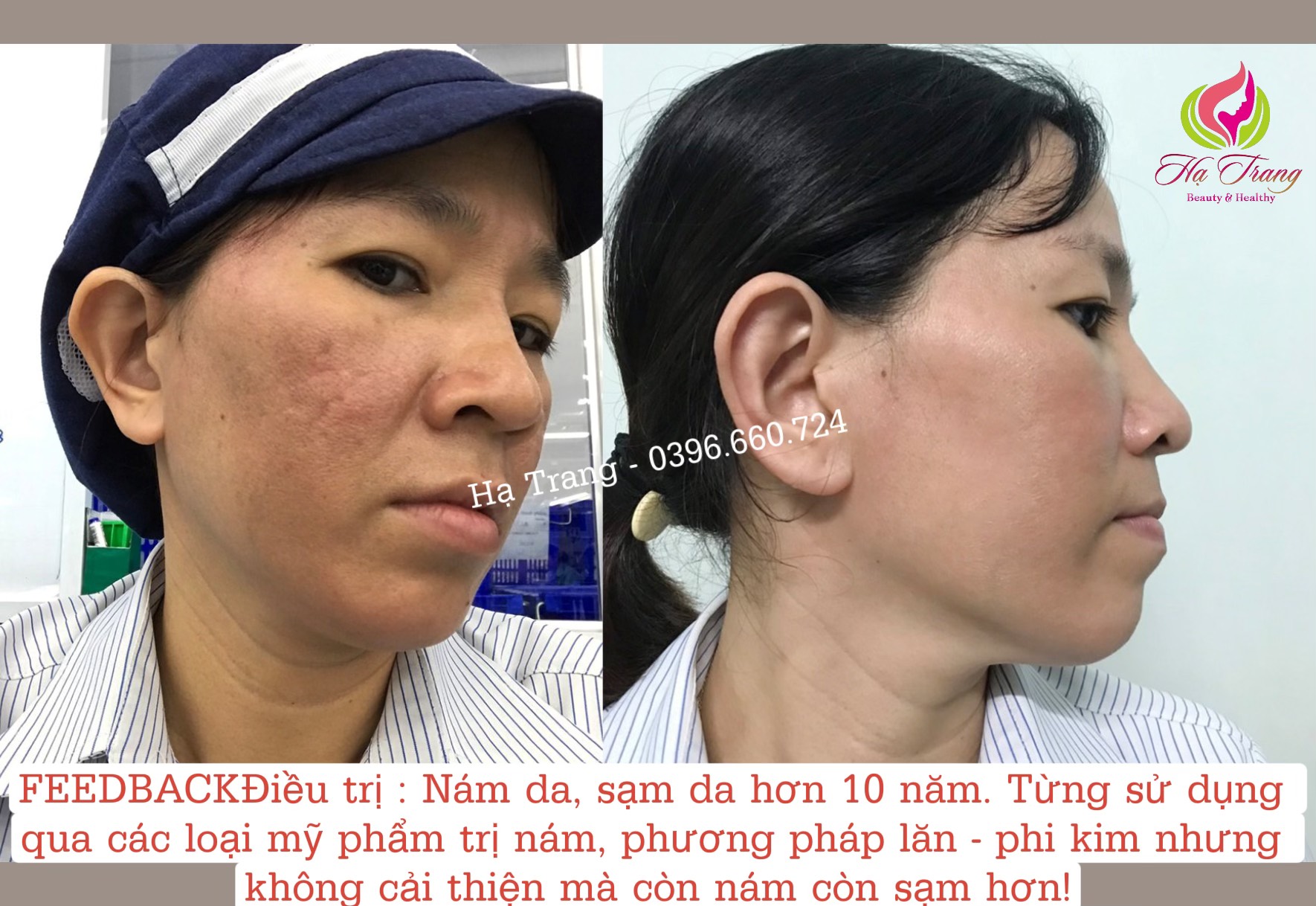 Kem Nám Bạch Hồng Đơn ( 30gram) - Hàng chuẩn Cty