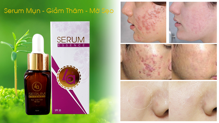 Serum Sạch mụn- Giãm thâm - Mờ sẹo LA 10ml