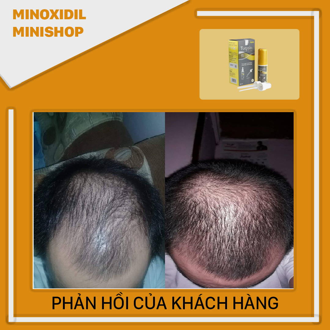 Minoxidil 10% Mọc Râu Tóc Tugain Solulion