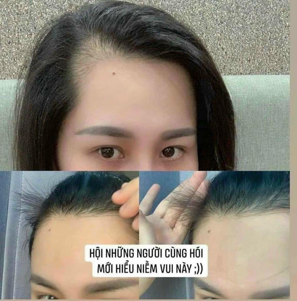 Mọc tóc 𝐒𝐀𝐓𝐎 𝐍𝐇𝐀̣̂𝐓 𝐁𝐀̉𝐍 🌳🌳